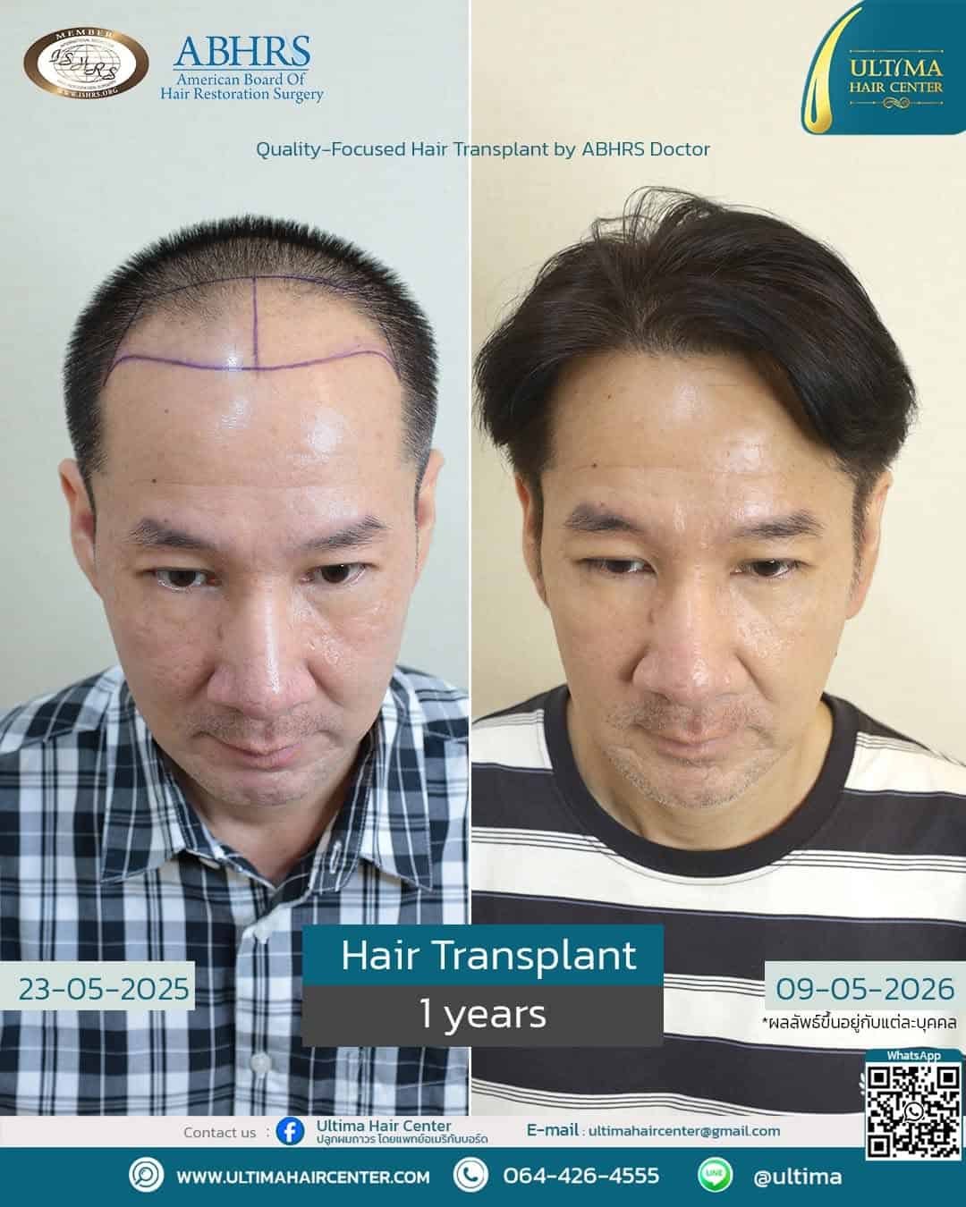 ปลูกผมได้ประโยชน์อย่างไร