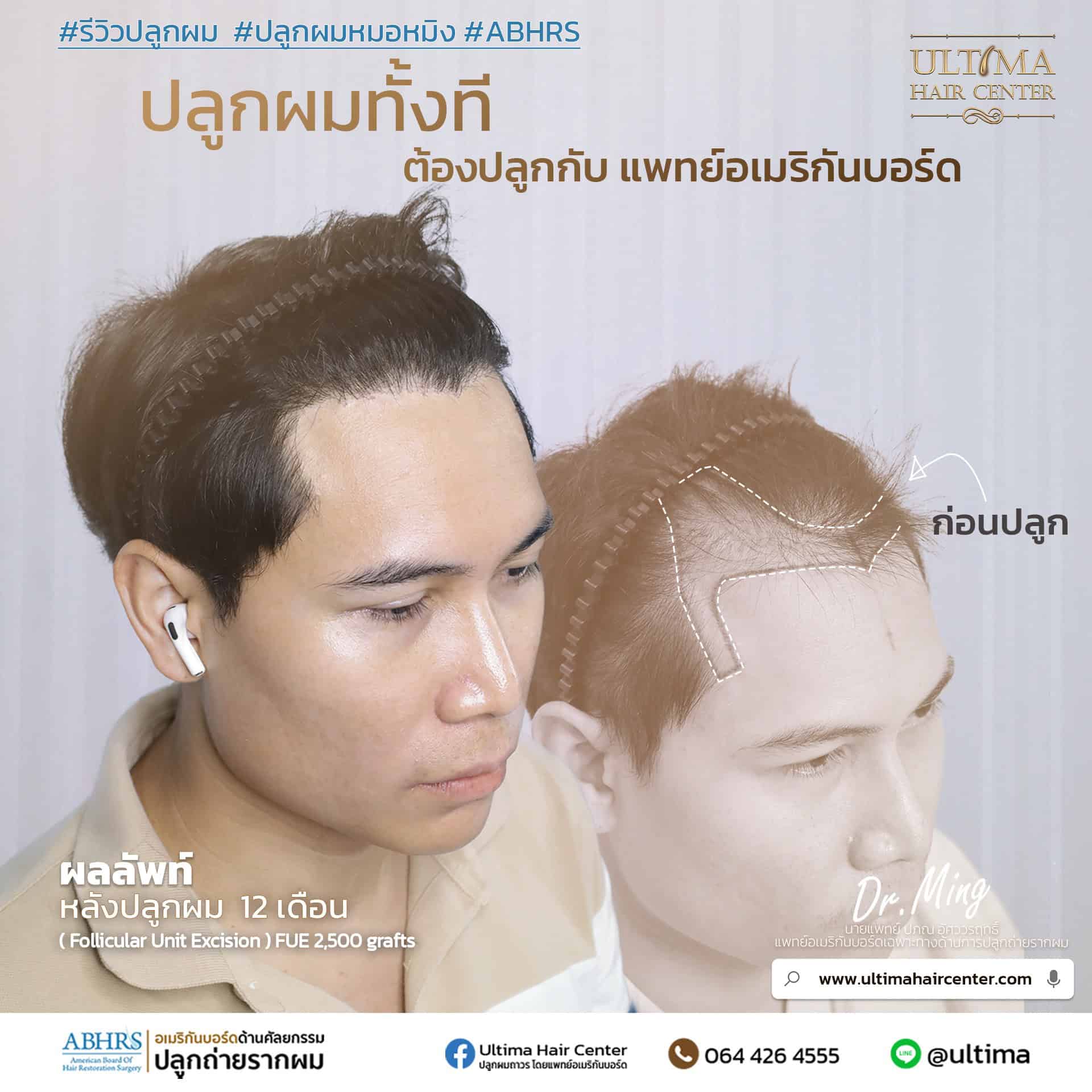 หน้าผากกว้างตั้งแต่เกิด กับ หัวเถิกจากกรรมพันธุ์ ต่างกันอย่างไร หน้าผากกว้างตั้งแต่เกิด กับ หัวเถิกจากกรรมพันธุ์ ต่างกันอย่างไร