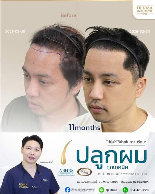 ปลูกผมในผู้ชายสามารถทำส่วนใดได้บ้าง