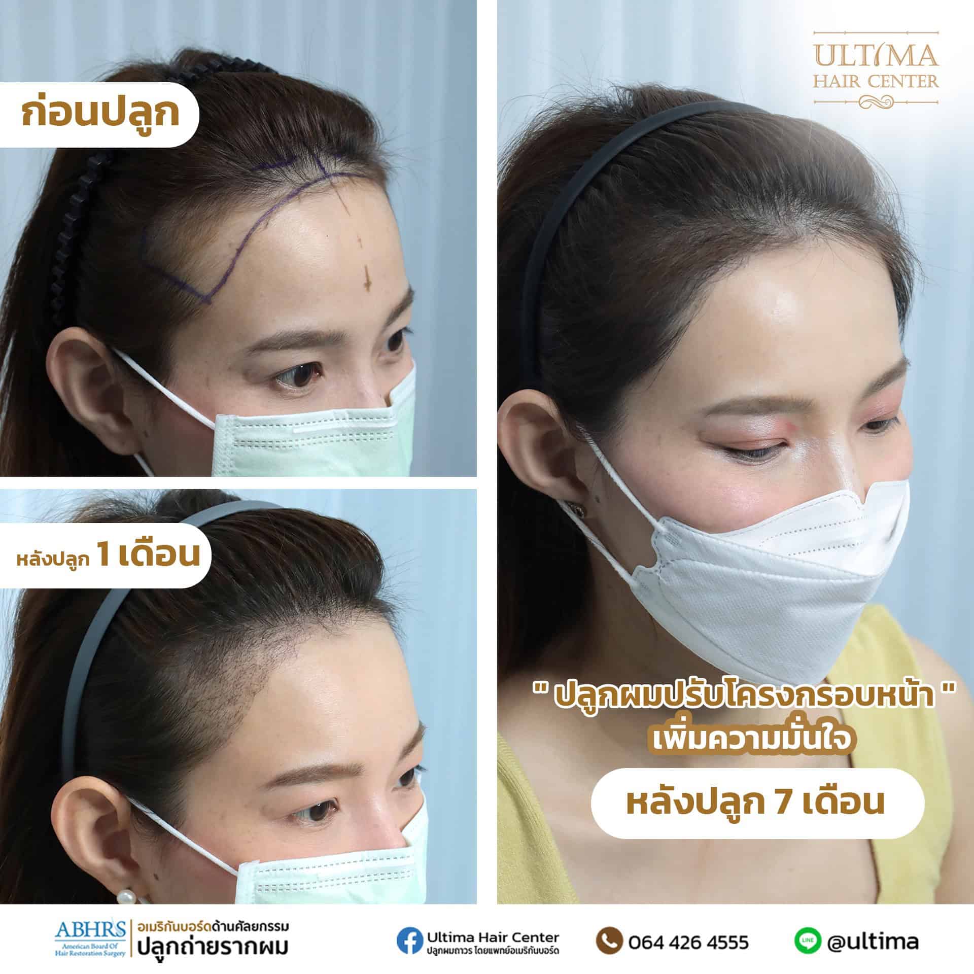 ผมร่วงจากการสระผมผิดปกติไหม