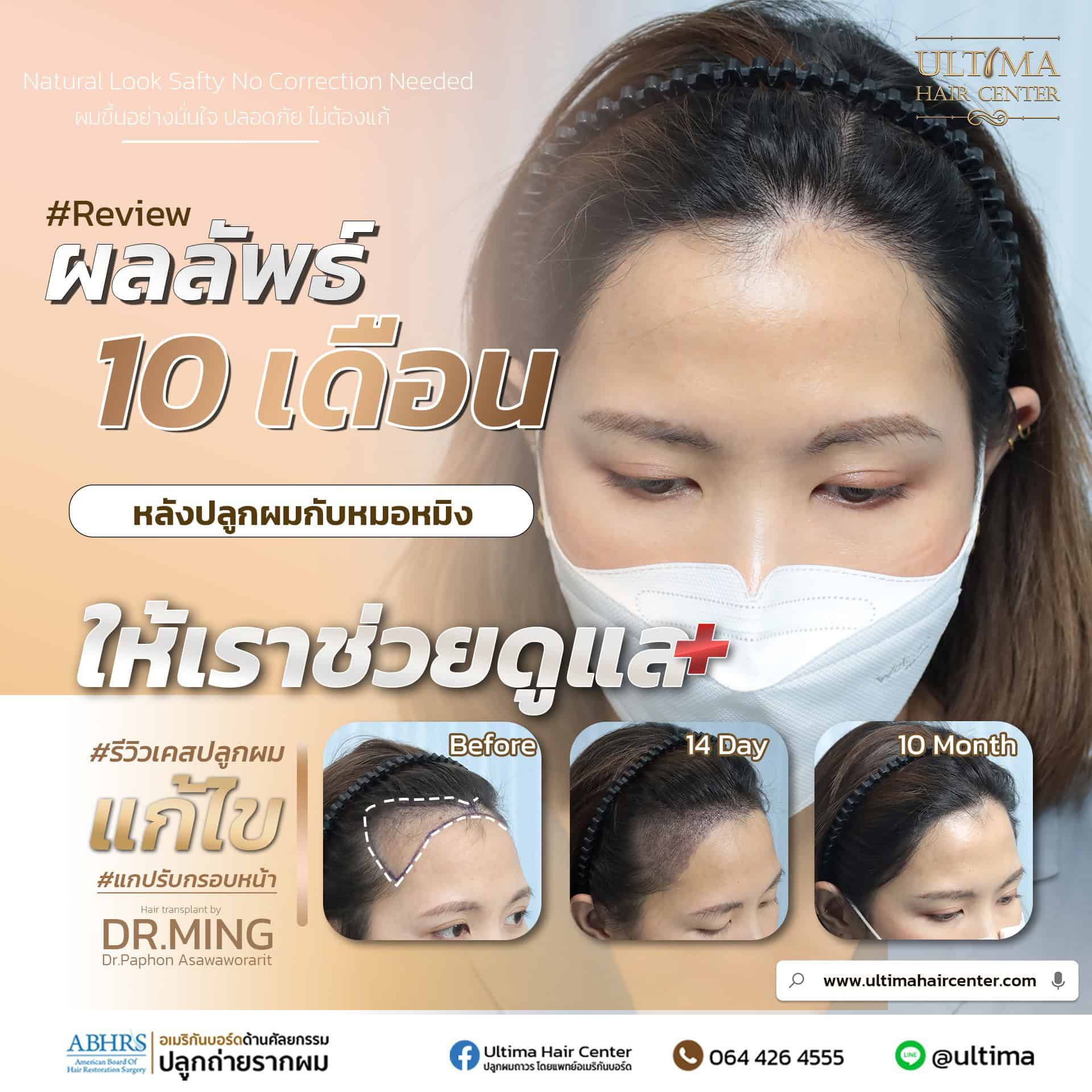 เราสามารถปลูกผมได้กี่ครั้ง