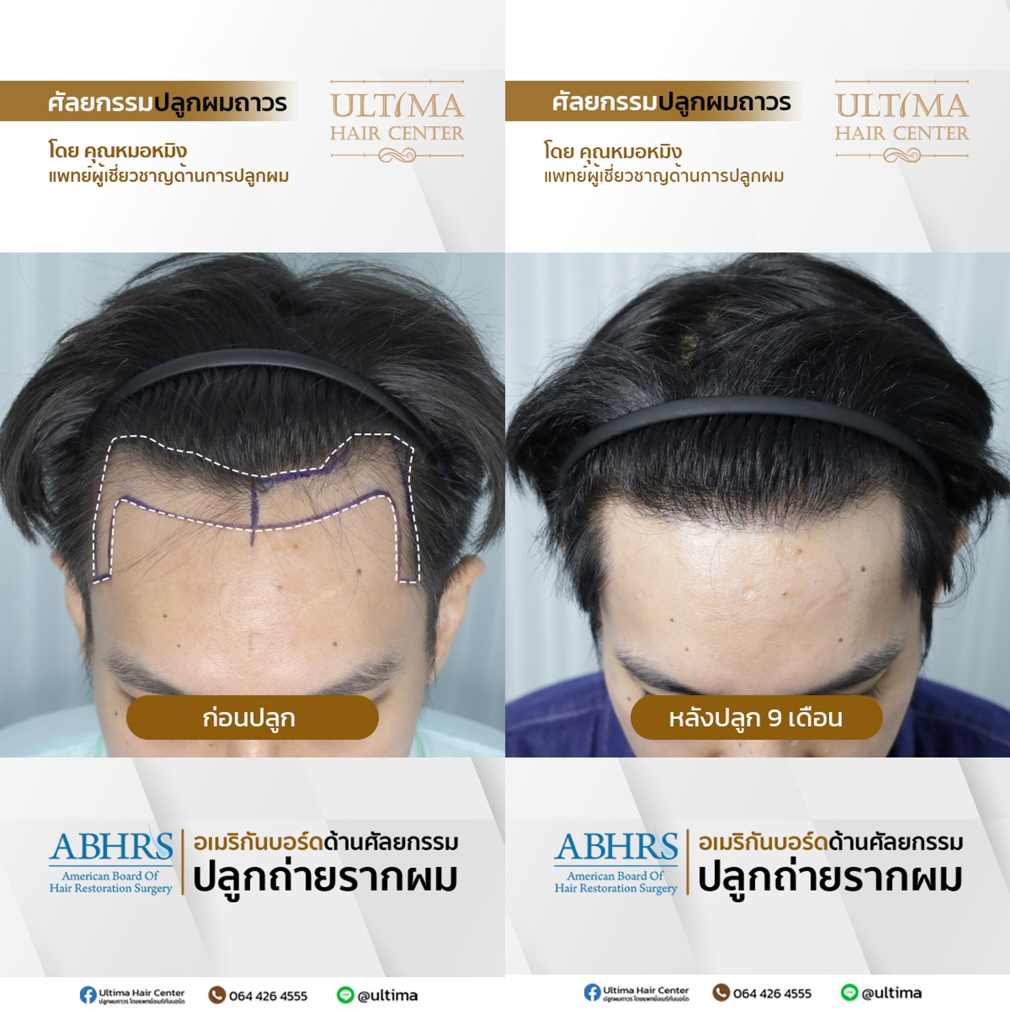 แพทย์ปลูกผม ABHRS กรุงเทพ คืออะไร