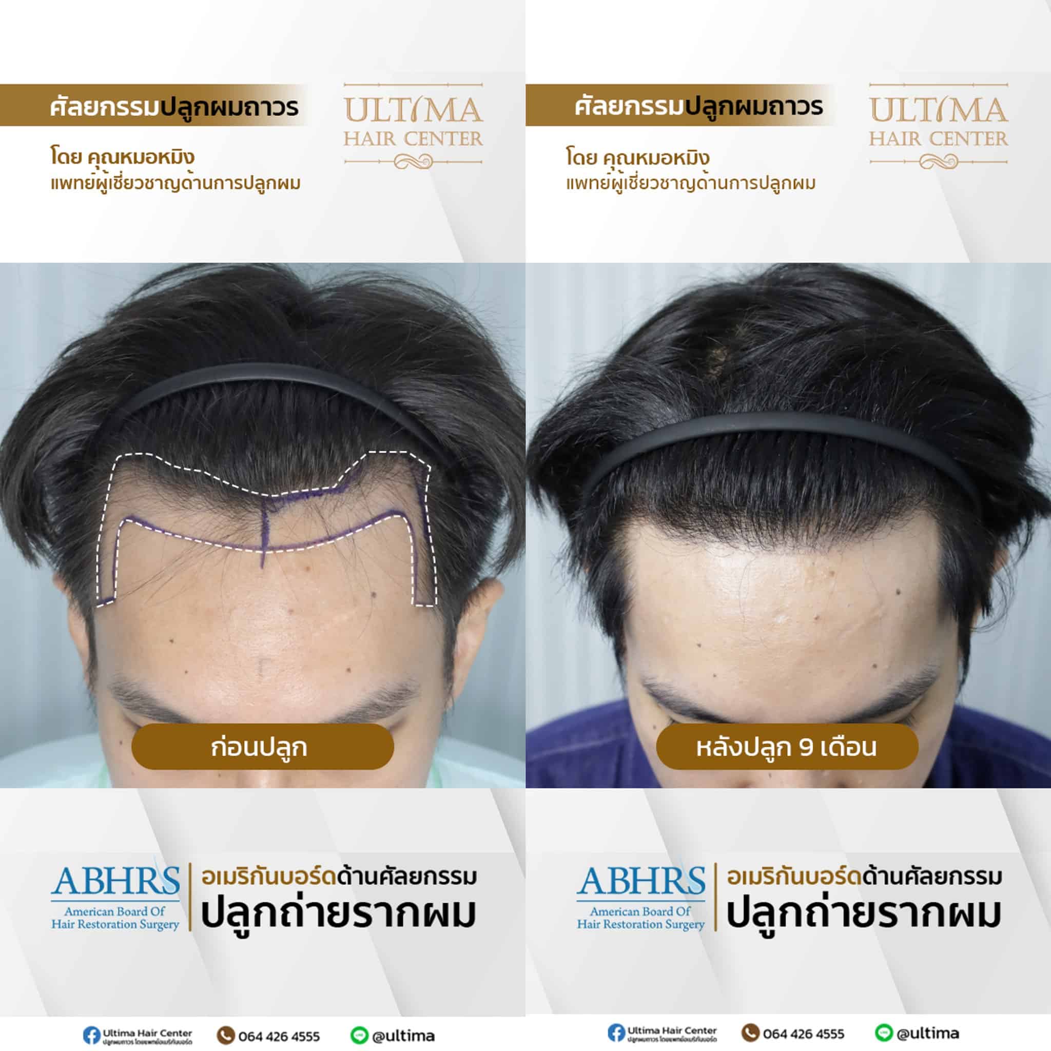 หน้าผากกว้างตั้งแต่เกิด กับ หัวเถิกจากกรรมพันธุ์ ต่างกันอย่างไร