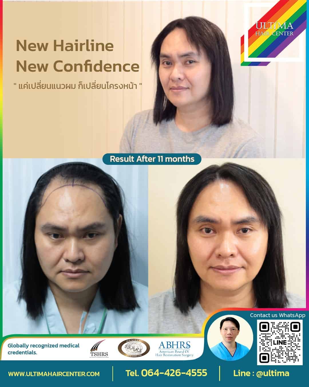 ปลูกผมLGBQ