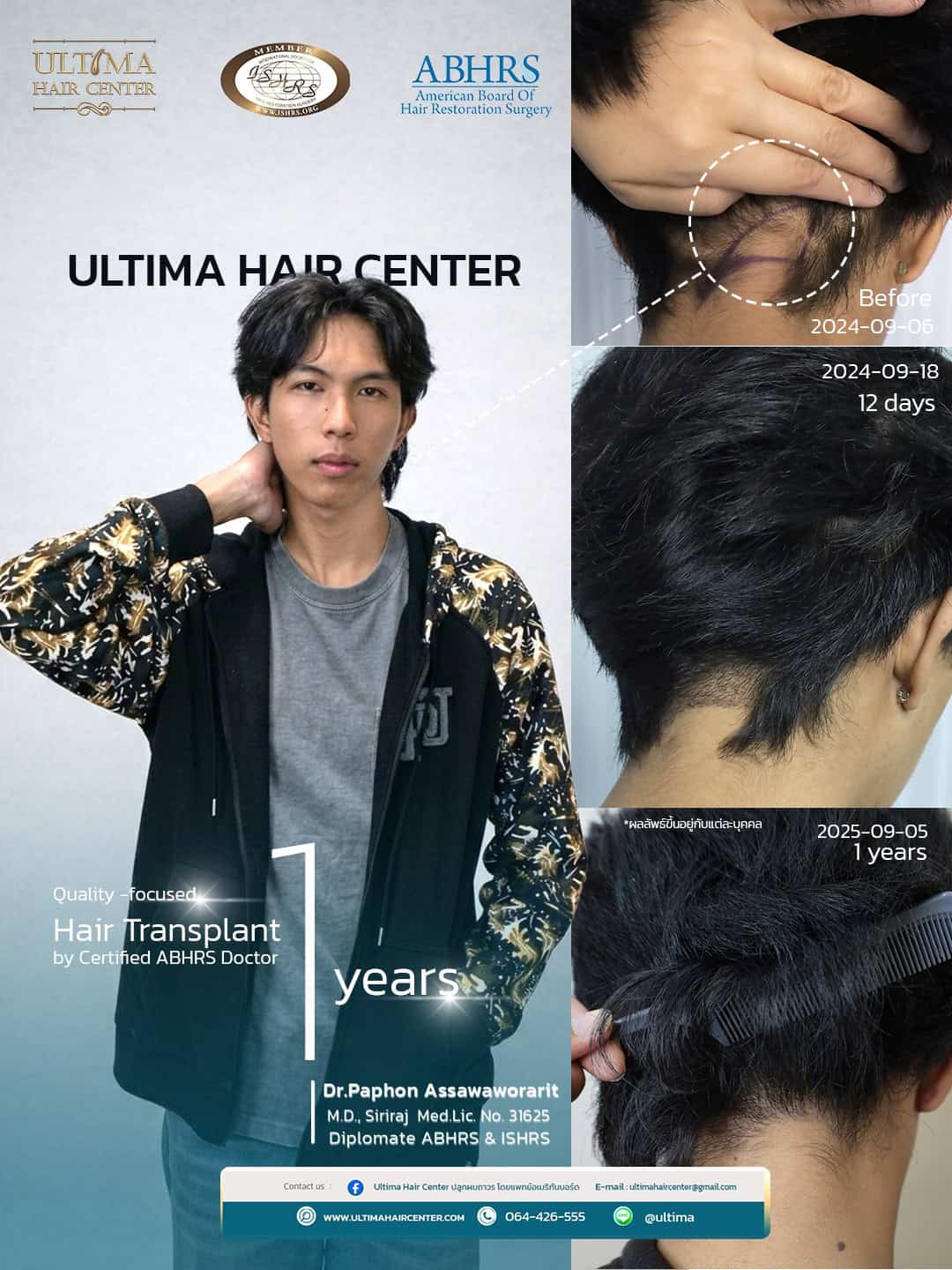 ปลูกผมปิดแผลเป็นคืออะไร