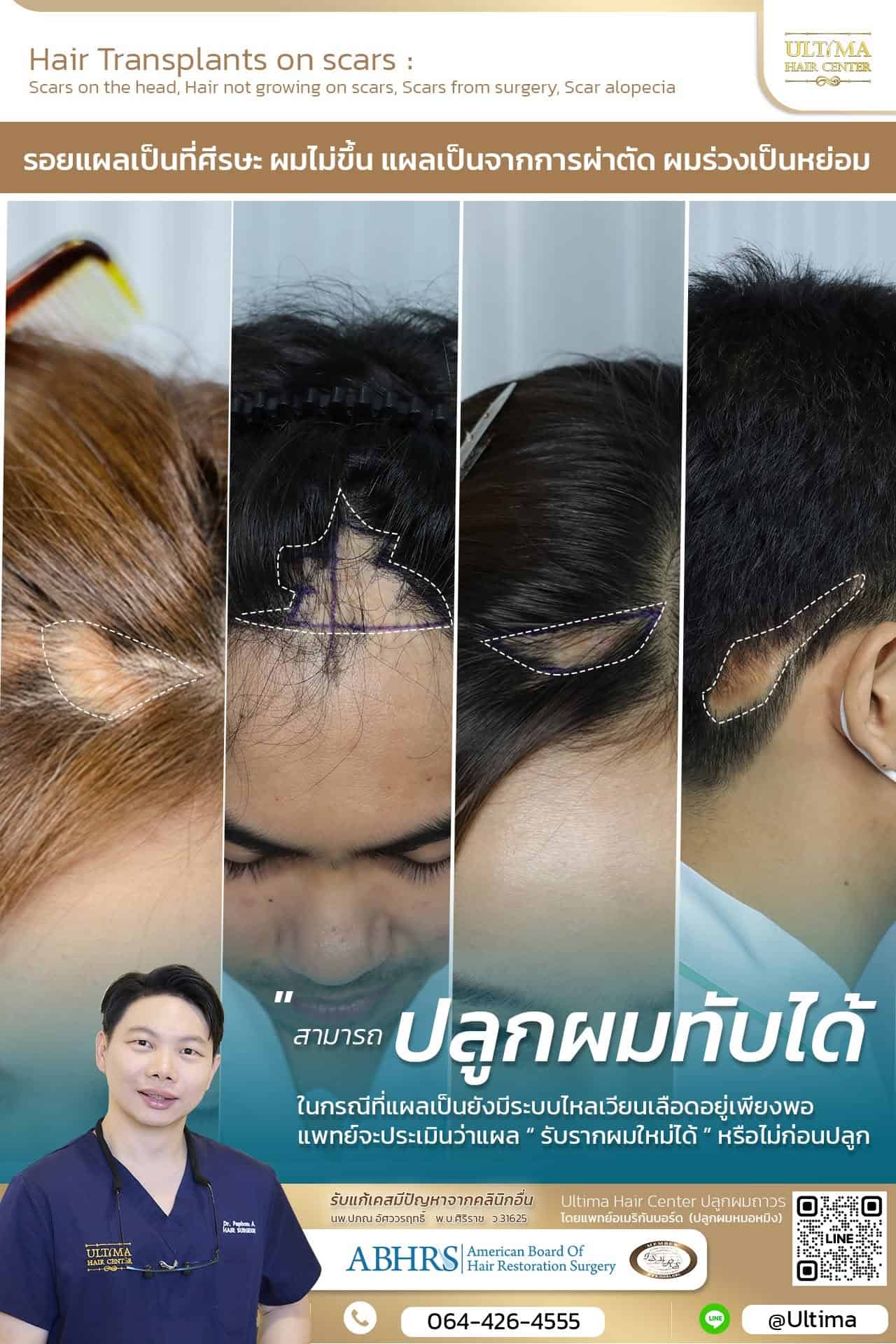ปลูกผมปิดแผลเป็นคืออะไร