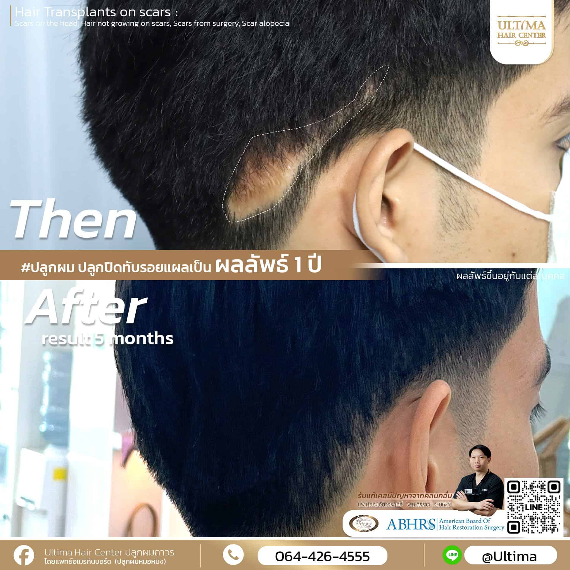 ปลูกผมทับแผลเป็น