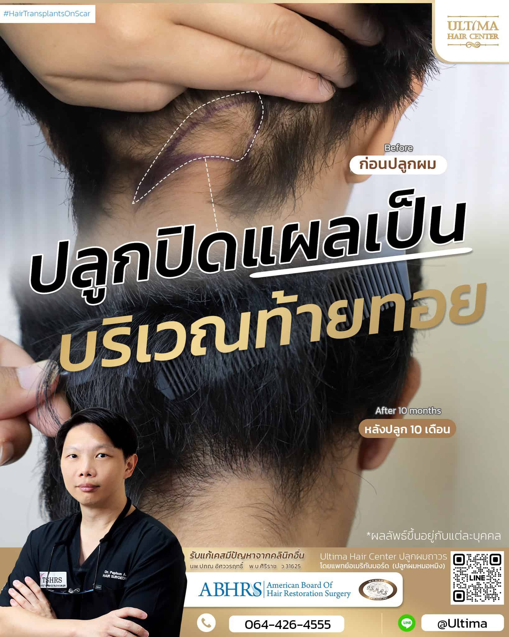 ปลูกผมปิดแผลเป็นคืออะไร