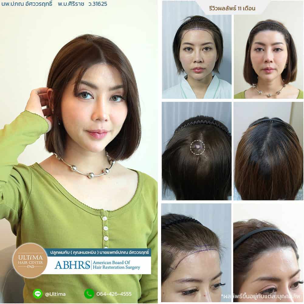 ปลูกผมปิดแผลเป็นคืออะไร