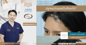 ปลูกผมปิดแผลเป็นคืออะไร