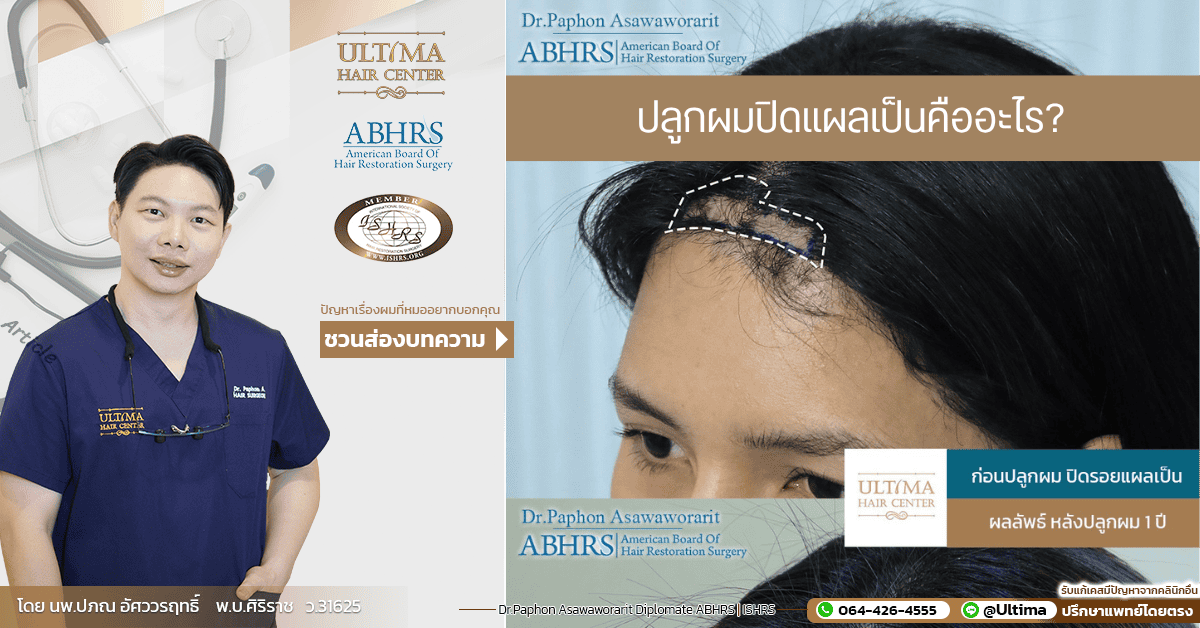 ปลูกผมปิดแผลเป็นคืออะไร ปลูกผมปิดแผลเป็นคืออะไร