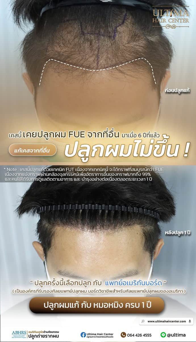 ปลูกผมแก้