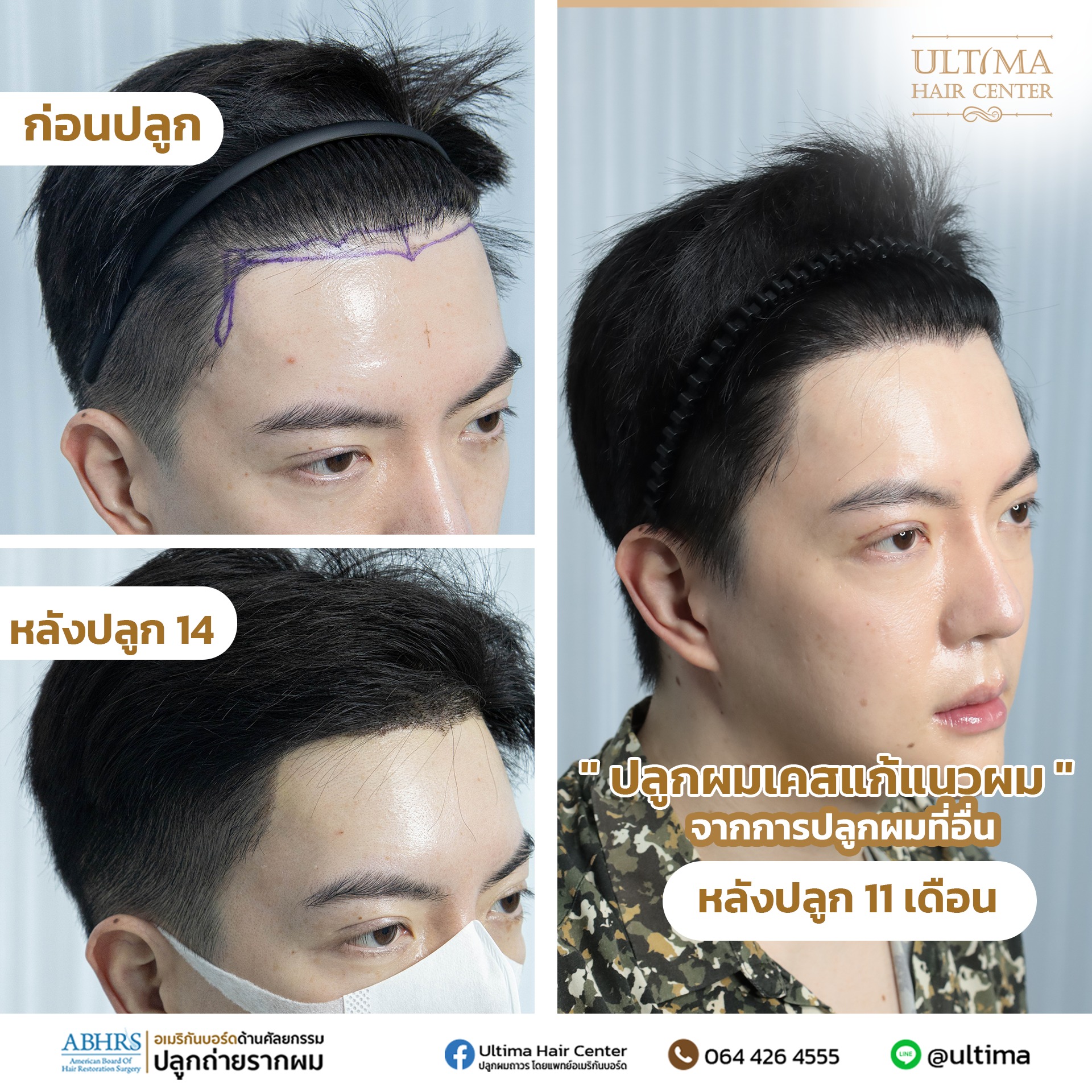 ปลูกผมในผู้ชายสามารถทำส่วนใดได้บ้าง