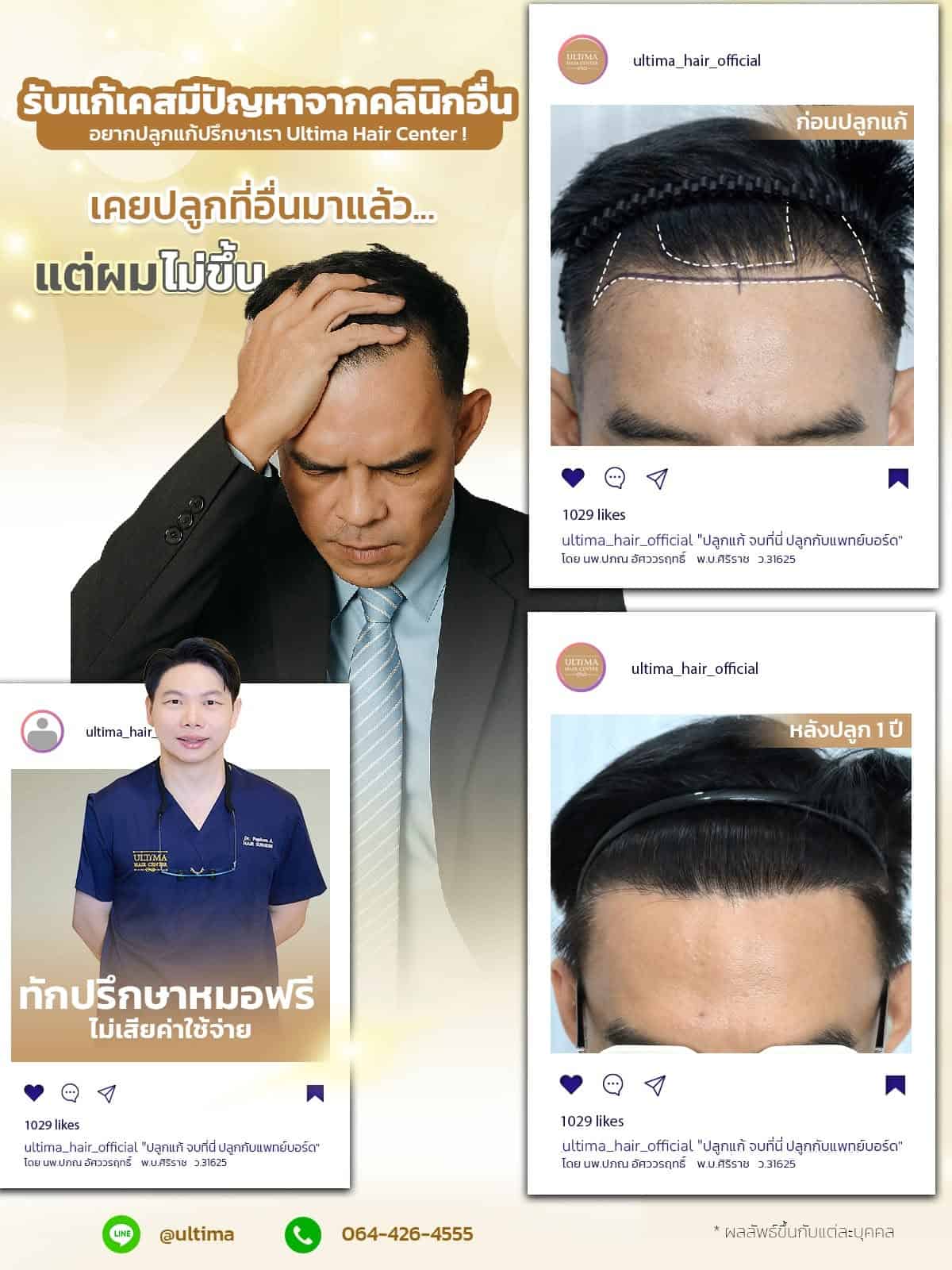 ปลูกผมครั้งที่ 2