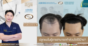 ปลูกผมในผู้ชายสามารถทำส่วนใดได้บ้าง