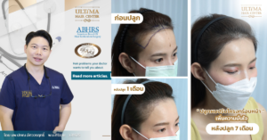คลินิกปลูกผม กรุงเทพ เลือกอย่างไร