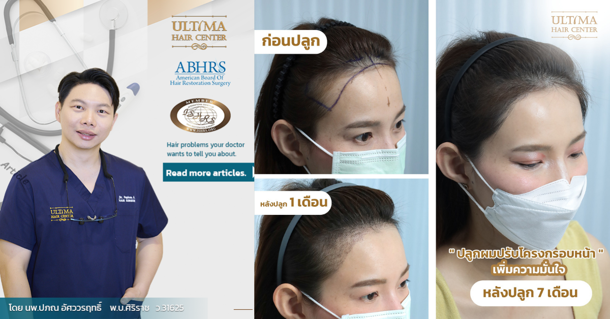 ปลูกผมในผู้หญิงสามารถทำส่วนใดได้บ้าง