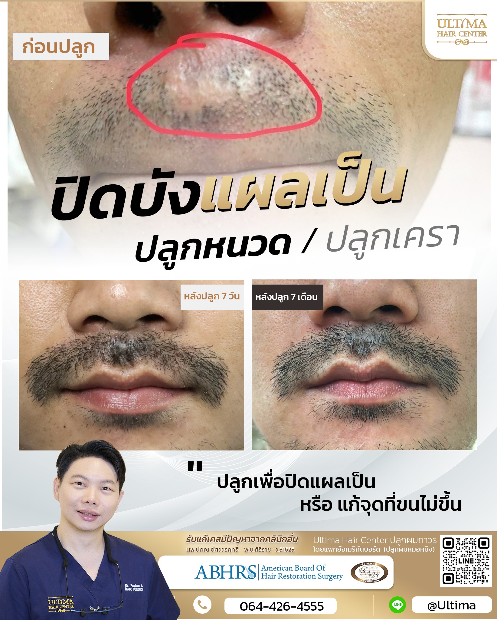ปลูกผมในผู้ชายสามารถทำส่วนใดได้บ้าง