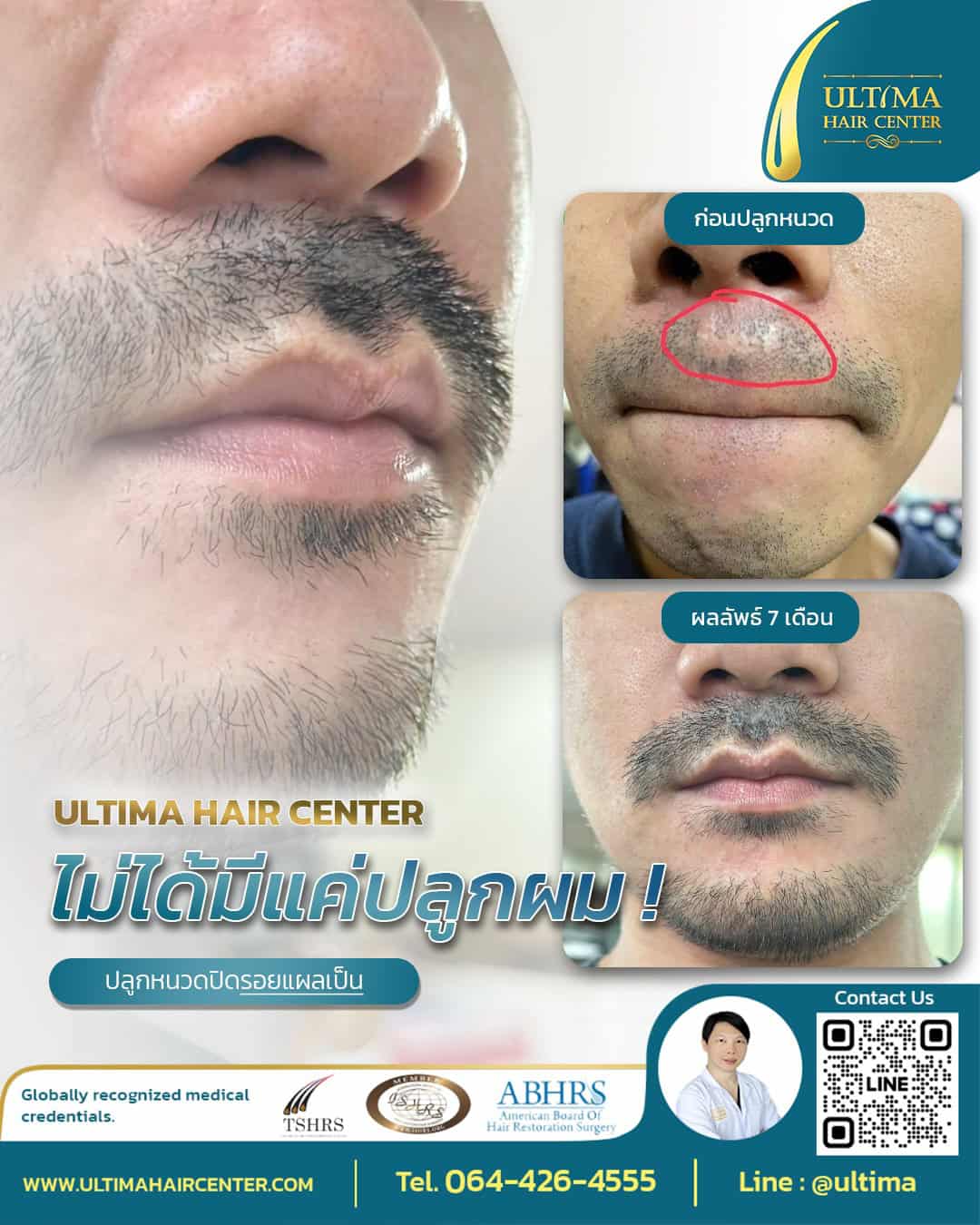 ปลูกหนวด