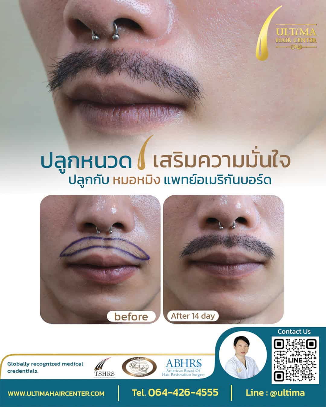 ปลูกหนวด