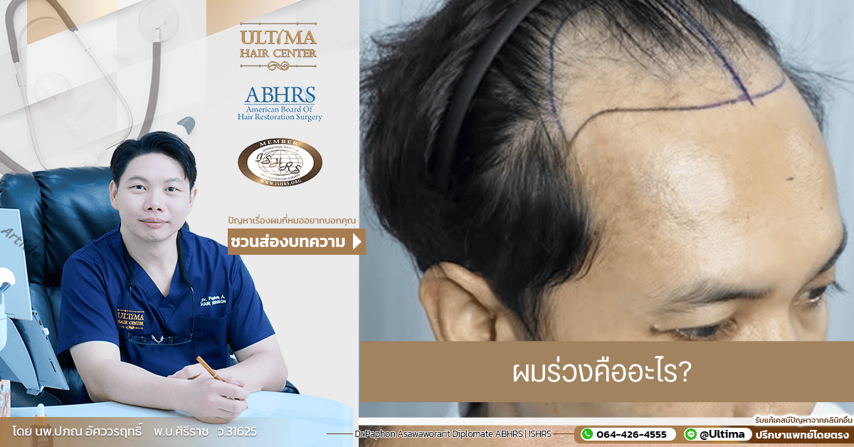 ผมร่วงคืออะไร ผมร่วงคืออะไร