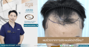 ผมร่วงจากการสระผมผิดปกติไหม