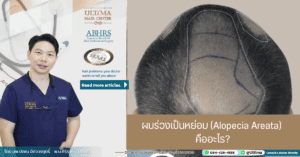 ผมร่วงเป็นหย่อม (Alopecia Areata) คืออะไร