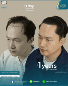 ปลูกผม