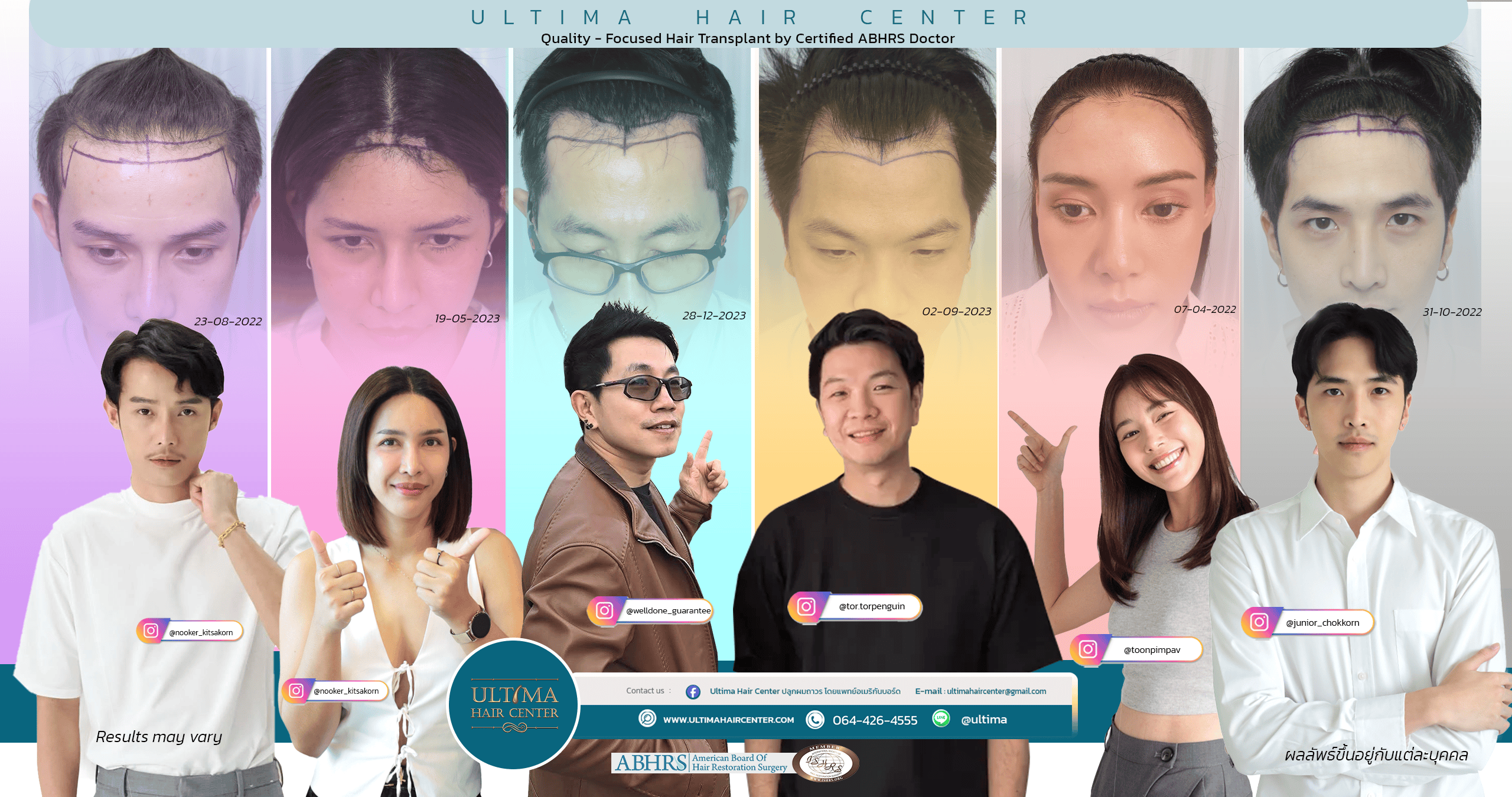 ปลูกผมในผู้ชายสามารถทำส่วนใดได้บ้าง