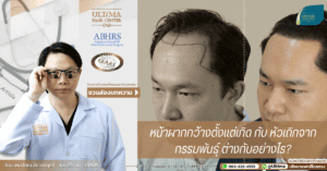 หน้าผากกว้างตั้งแต่เกิด กับ หัวเถิกจากกรรมพันธุ์ ต่างกันอย่างไร