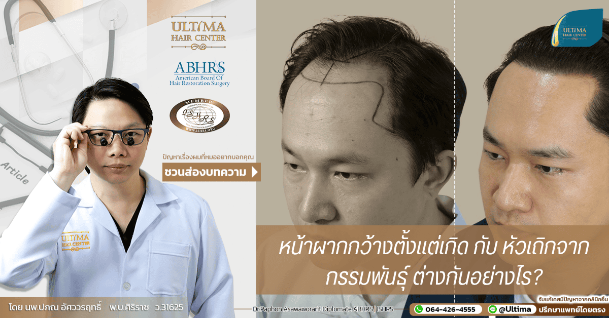 หน้าผากกว้างตั้งแต่เกิด กับ หัวเถิกจากกรรมพันธุ์ ต่างกันอย่างไร หน้าผากกว้างตั้งแต่เกิด กับ หัวเถิกจากกรรมพันธุ์ ต่างกันอย่างไร