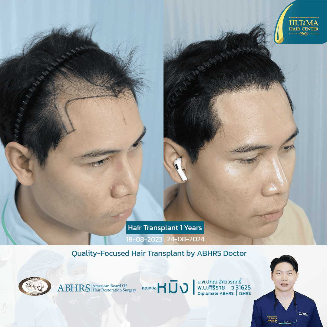 ปลูกผมได้ประโยชน์อย่างไร
