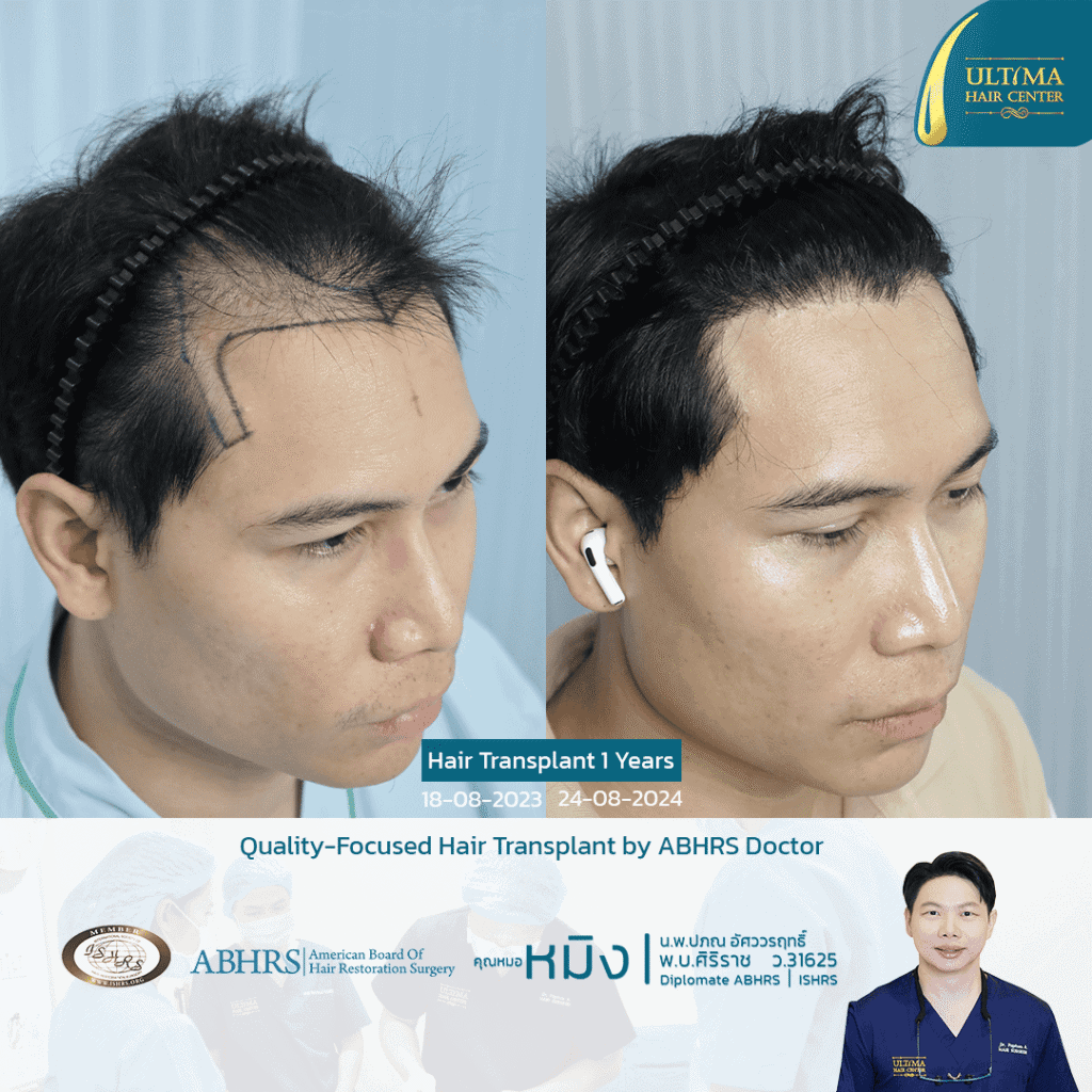 ปลูกผมโซนบางกะปิ กรุงเทพกรีฑา เลือกคลินิกอย่างไร